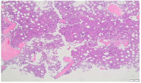 Clinics and Practice, Vol. 12, Pages 1069-1077: Portal Vein Thrombosis after C-Section in a Patient with Polycythemia Vera (PV) Due to Pregnancy and Iron Deficiency Anemia (IDA)