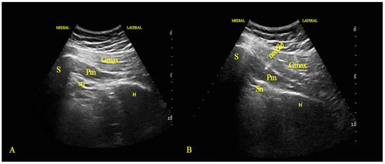 Healthcare, Vol. 11, Pages 95: Efficacy of Ultrasound-Guided Injection of Botulinum Toxin, Ozone, and Lidocaine in Piriformis Syndrome