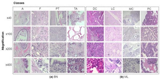 Diagnostics, Vol. 13, Pages 103: Efficient Breast Cancer Classification Network with Dual Squeeze and Excitation in Histopathological Images