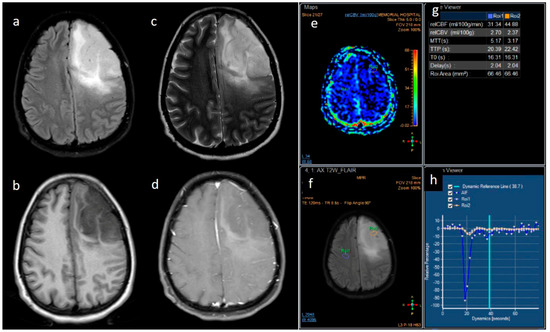 JPM, Vol. 13, Pages 72: Multiparametric Magnetic Resonance Imaging Correlates of Isocitrate Dehydrogenase Mutation in WHO high-Grade Astrocytomas