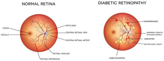 Diagnostics, Vol. 13, Pages 124: EDLDR: An Ensemble Deep Learning Technique for Detection and Classification of Diabetic Retinopathy