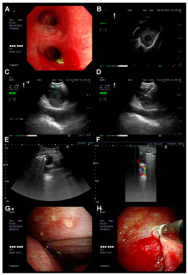 Diagnostics, Vol. 13, Pages 129: The Feasibility of Interventional Pulmonology Methods for Detecting the T790M Mutation after the First or Second-Generation EGFR-TKI Resistance of Non-Small Cell Lung Cancer