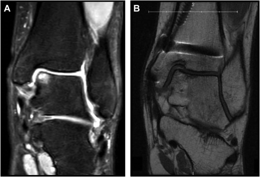 Advances in Cartilage Repair