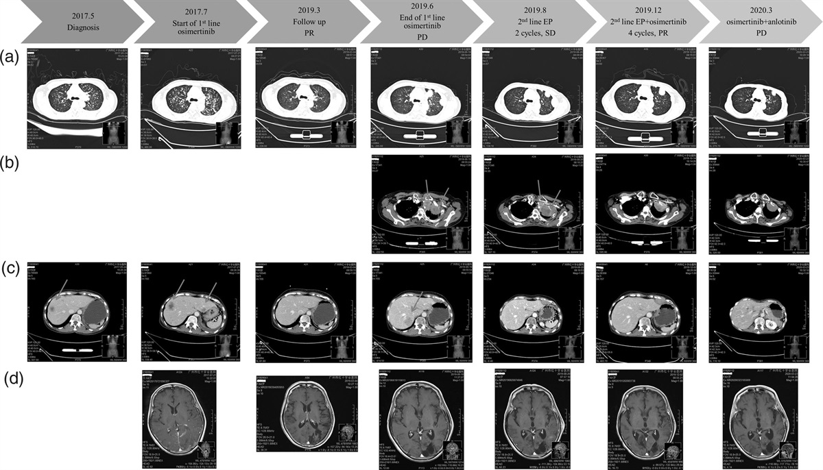 Reuse of osimertinib after small cell lung cancer transformation in lung adenocarcinoma with de-novo epidermal growth factor receptor T790M mutation: case report