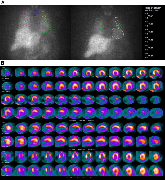 What Is New in Risk Assessment in Nuclear Cardiology?