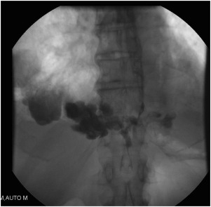 Esophageal Perforation