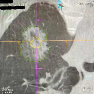 Stereotactic Body Radiation Therapy Versus Ablation Versus Surgery for Early-Stage Lung Cancer in High-Risk Patients