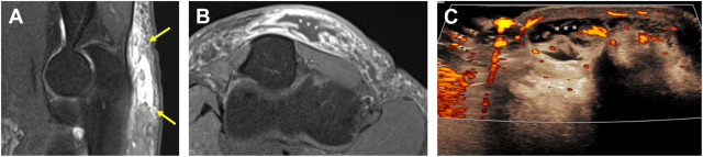 Acute and Chronic Elbow Disorders