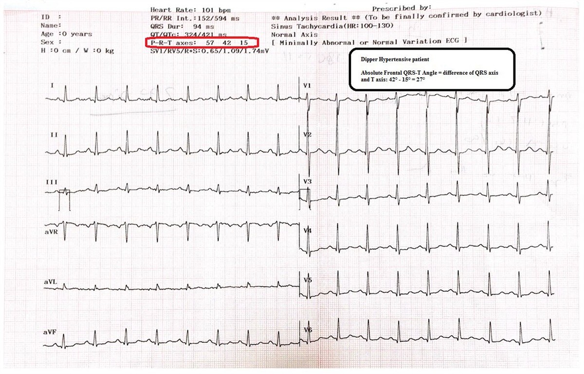 The association between frontal QRS-T angle and reverse dipper status in newly diagnosed hypertensive patients