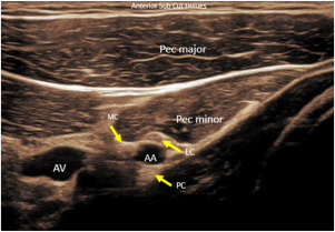 Brachial Plexus Nerve Injuries and Disorders