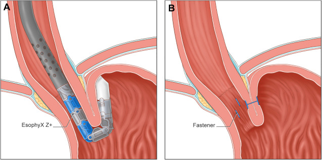 Gastroesophageal Reflux Disease in 2023