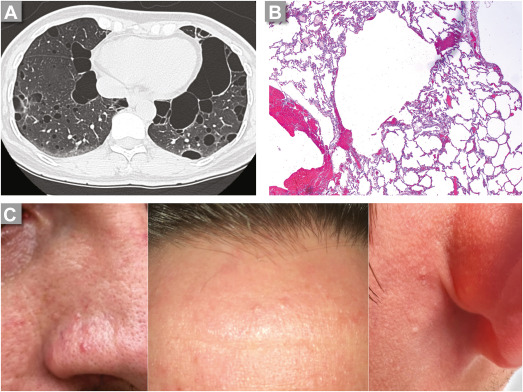 Lymphangioleiomyomatosis and Other Cystic Lung Diseases