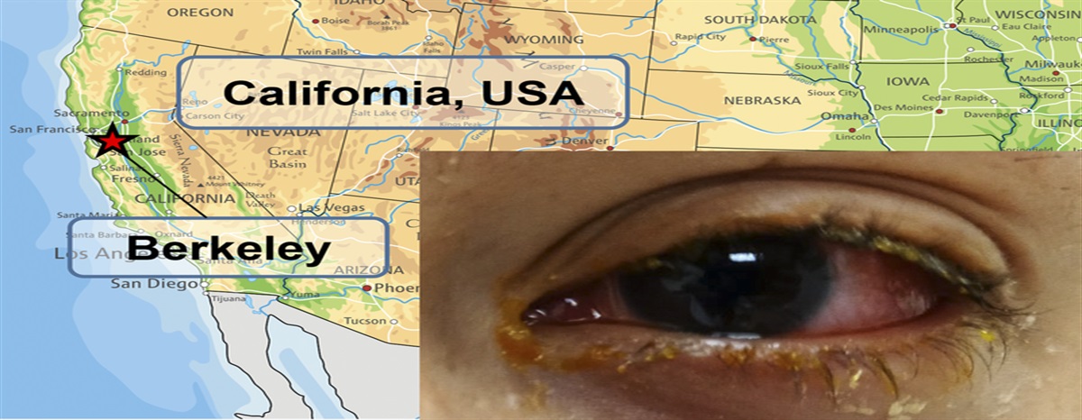 Case Series: Unbiased Deep Sequencing Analysis of Acute Infectious Conjunctivitis in an Ambulatory Eye Center in Berkeley, California