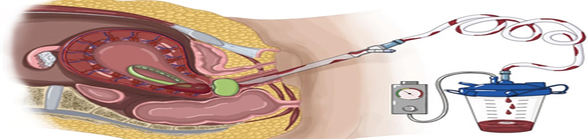 Interventions of Postpartum Hemorrhage