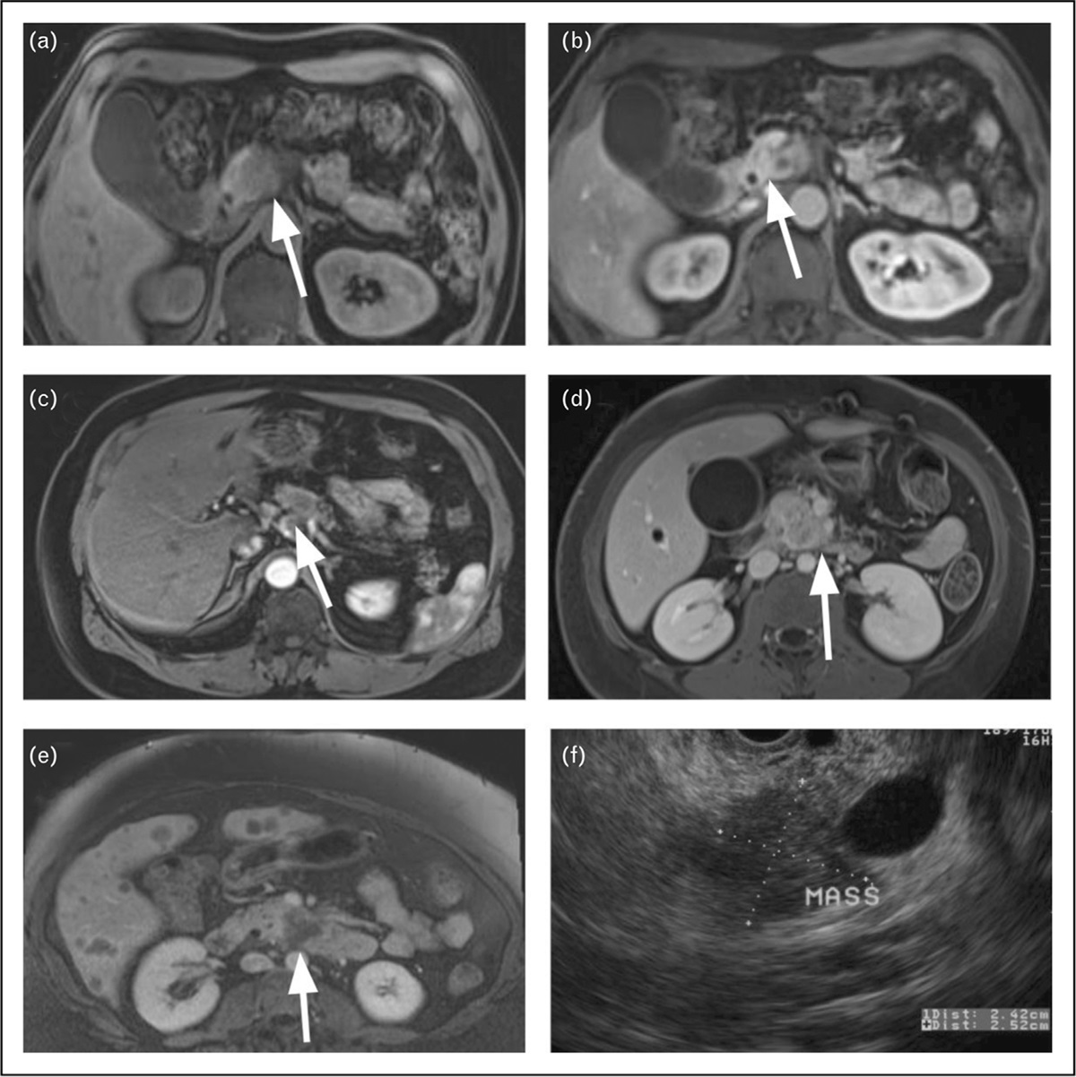 A review of deep learning and radiomics approaches for pancreatic cancer diagnosis from medical imaging