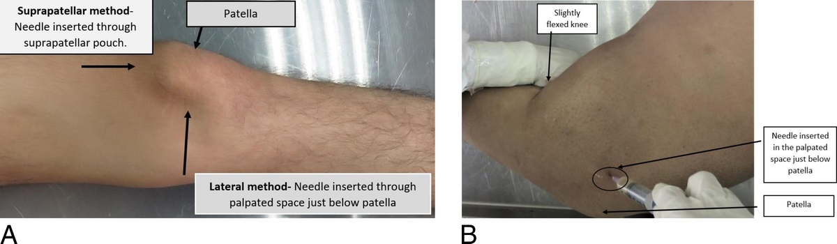 Estimation of Time Since Death Using Biochemical Markers in Synovial Fluid