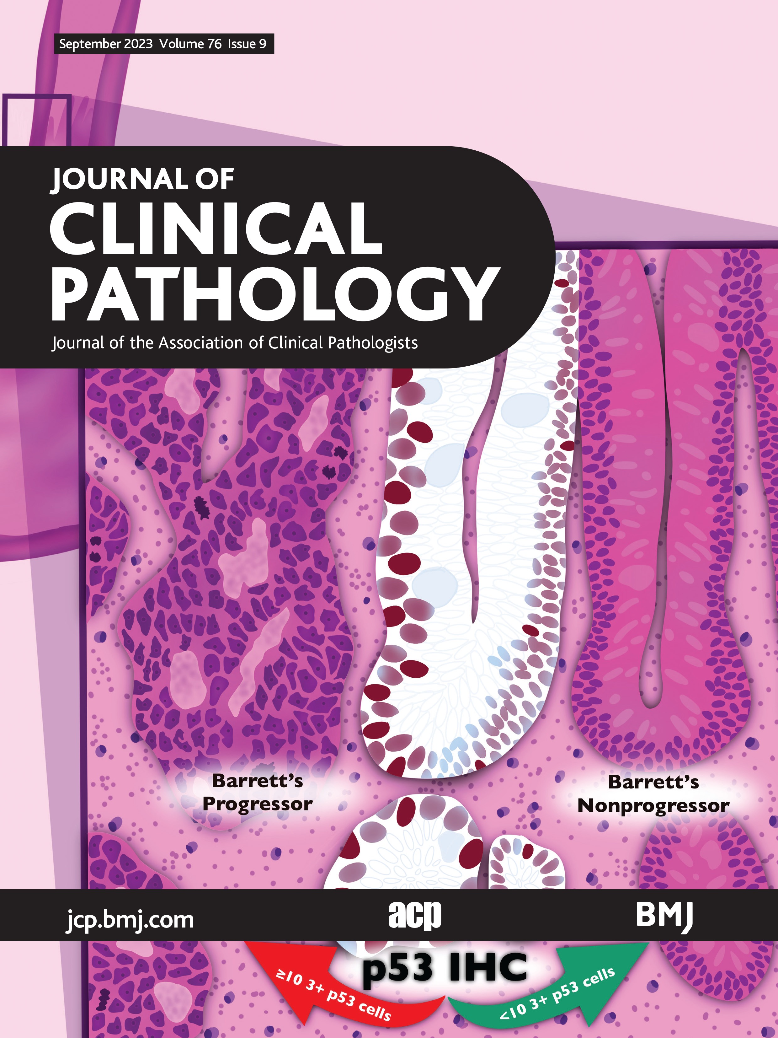 Quantitative p53 immunostaining aids in the detection of prevalent dysplasia