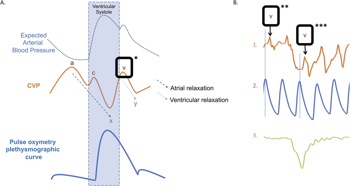 RESPIRATION-RELATED VARIATIONS IN CENTRAL VENOUS PRESSURE AS PREDICTORS OF FLUID RESPONSIVENESS IN SPONTANEOUSLY BREATHING PATIENTS