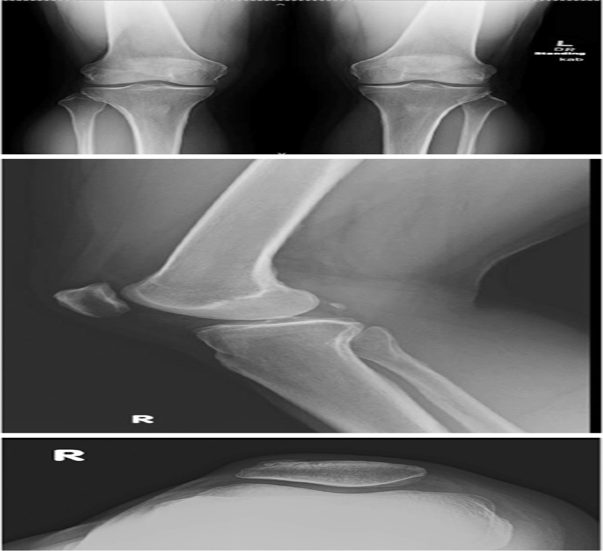 Medial Collateral Ligament Tear