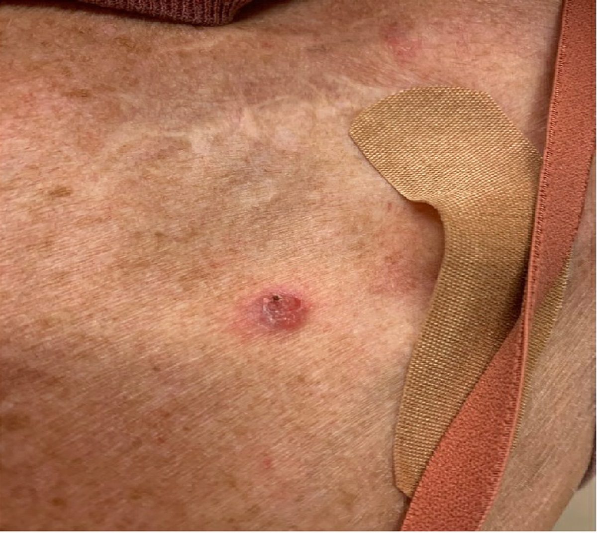 Amelanotic Melanoma Presents as Nonhealing Wound Near Port Site