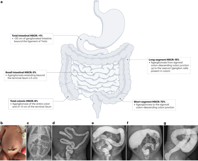 Hirschsprung disease