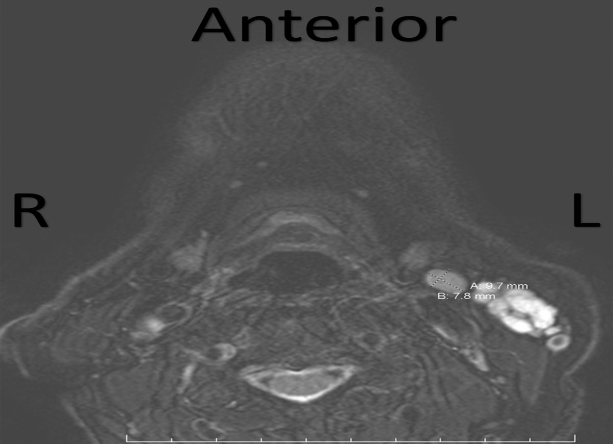 Optimizing Facial Function in Patients With High-Risk Recurrent Pleomorphic Adenoma and a History of Facial Nerve Injury