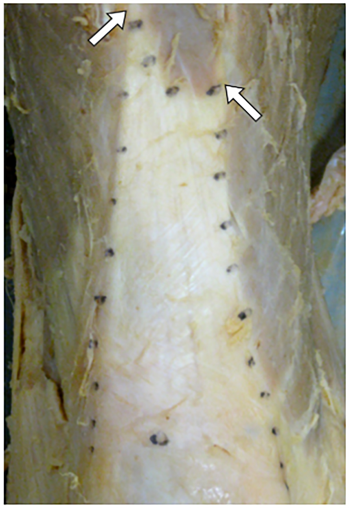 Role of Quadriceps Tendon Autograft in Primary and Revision Anterior Cruciate Ligament Reconstruction