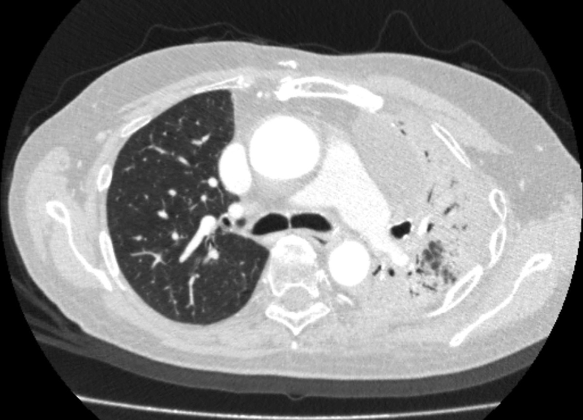 A late relapse thymoma and pure red cell aplasia case with an over 5 years of clinical response under everolimus