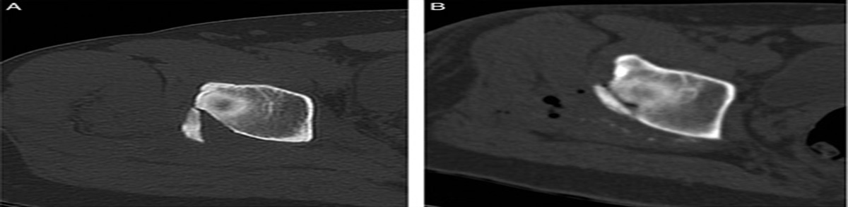 A single shot arthroscopic reduction and screw fixation of posterior wall acetabular fracture