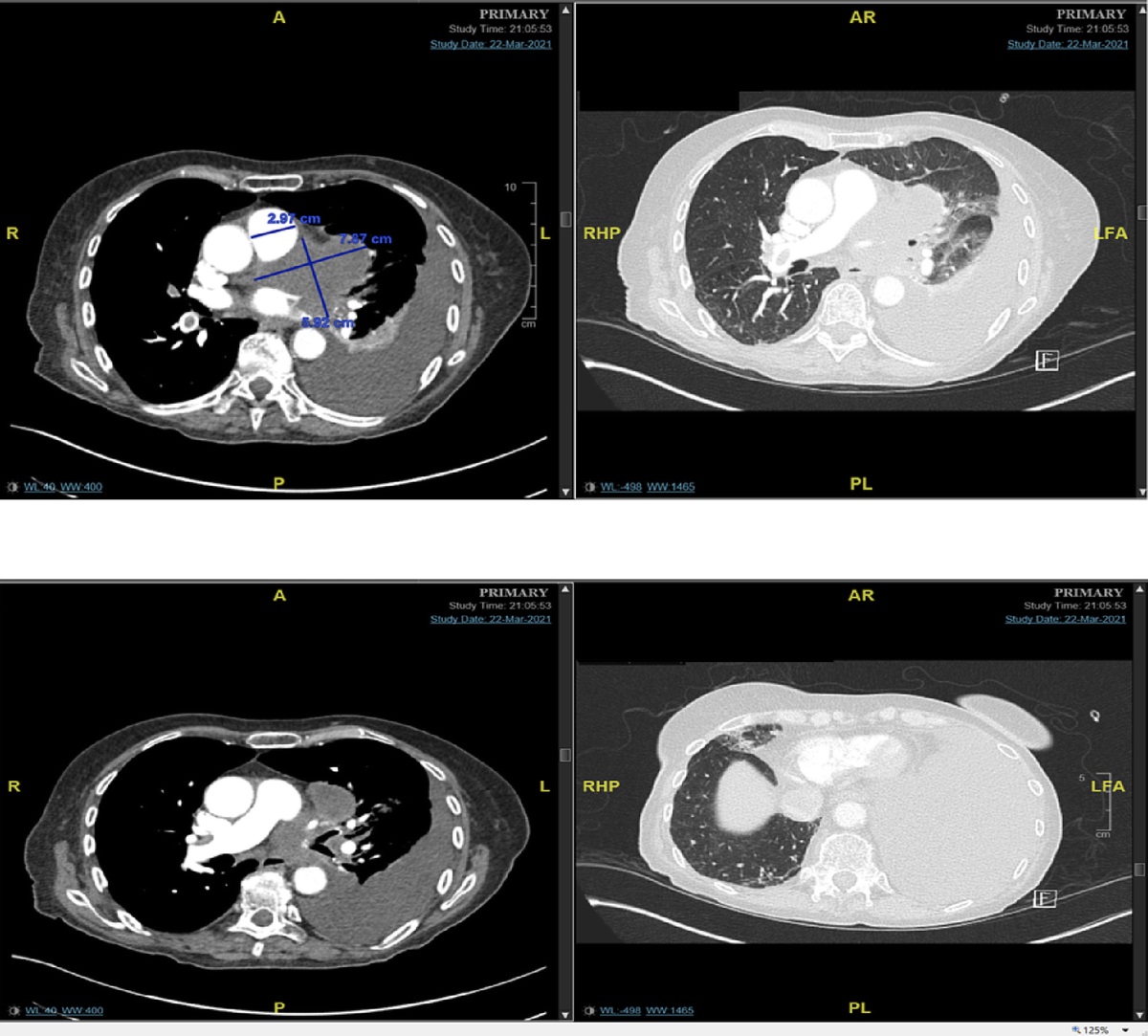 Thromboembolism in Cancer Patients With COVID-19 Infection Compared With Other Infections—A Case Series