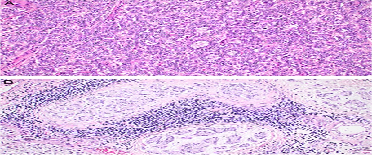 Germline APC Alterations May Predispose to Testicular Sex Cord-Stromal Tumors