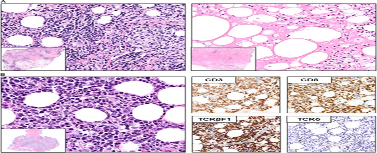 IRF8 in Conjunction With CD123 and CD20 to Distinguish Lupus Erythematosus Panniculitis From Subcutaneous Panniculitis-like T-Cell Lymphoma