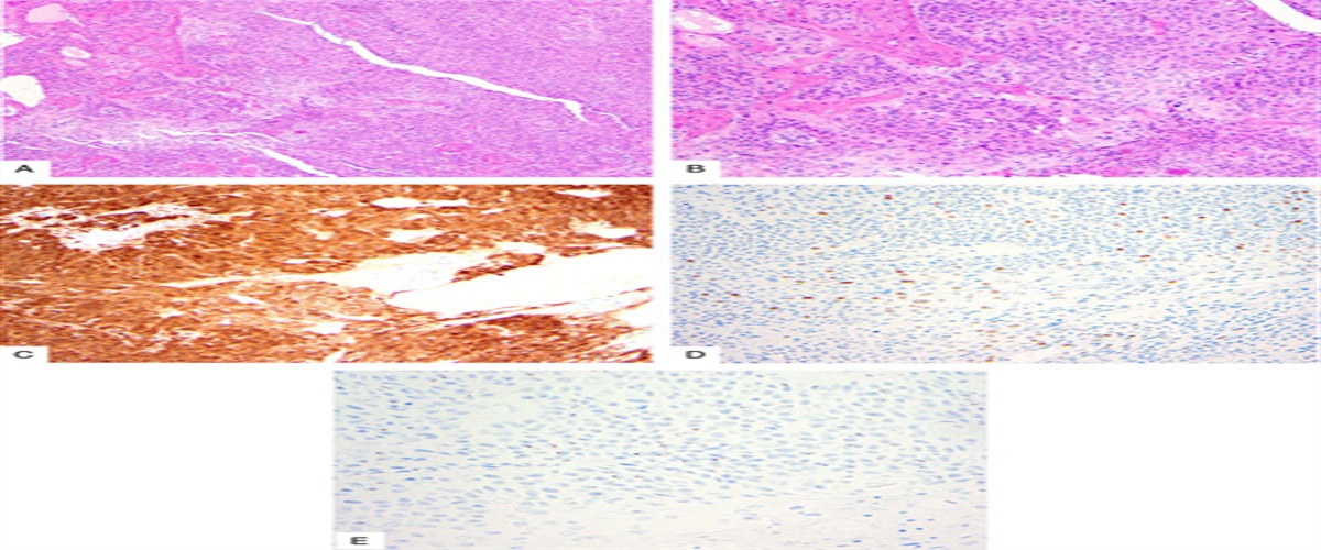 Incidence and Clinicopathologic Characteristics of Human Papillomavirus–independent Invasive Squamous Cell Carcinomas of the Cervix: A Morphologic, Immunohistochemical, and Human Papilloma-Virologic Study of 670 Cases