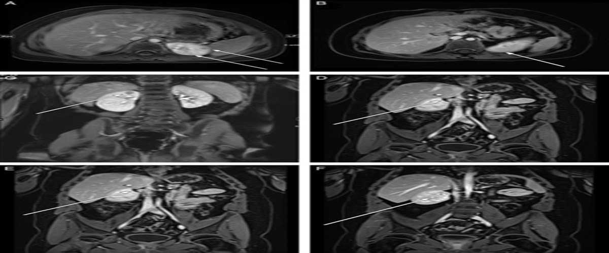 “Oncocytoid Renal Cell Carcinomas After Neuroblastoma” Represent TSC-mutated Eosinophilic Solid and Cystic Renal Cell Carcinomas: Association With Prior Childhood Malignancy and Multifocality With Therapeutic Implications