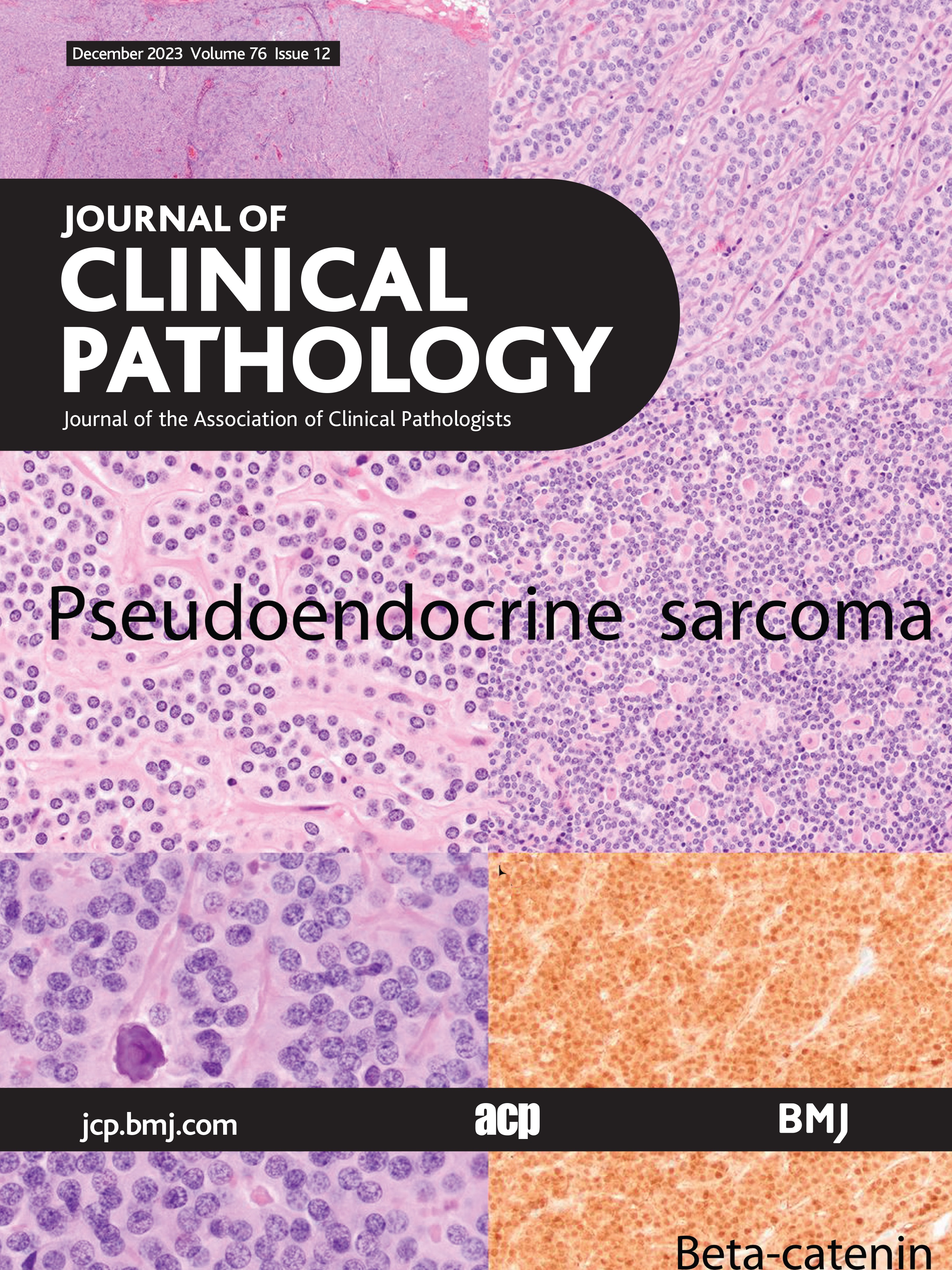 Emerging mesenchymal tumour types and biases in the era of ubiquitous sequencing