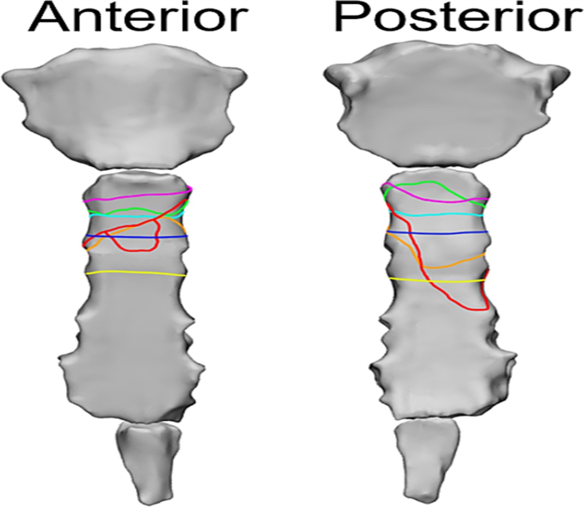 Surgical management of traumatic sternal body nonunions: Technical tricks and clinical experience