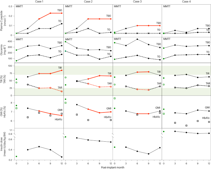 Encapsulated stem cell–derived β cells exert glucose control in patients with type 1 diabetes