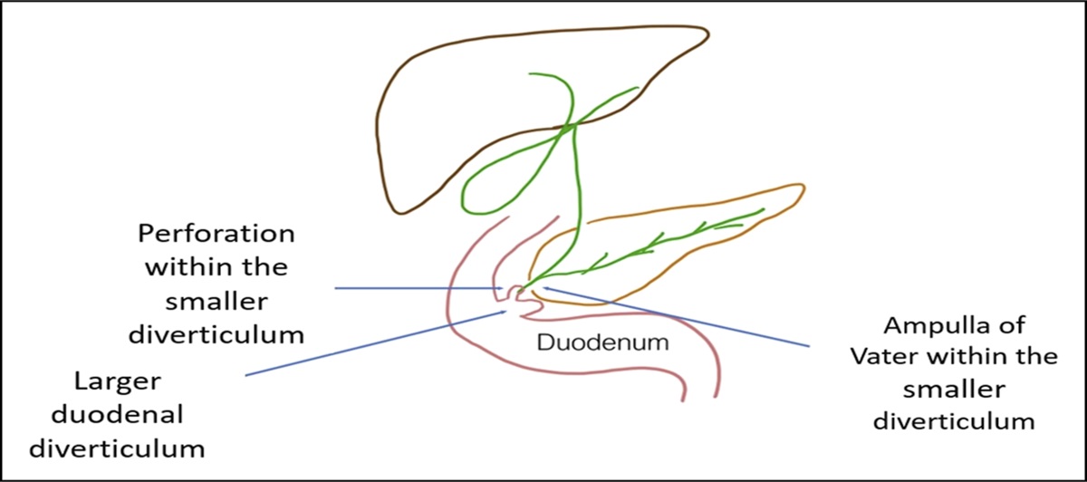 A Tale of 2 Tics: Endoscopic Treatment of Perforated Periampullary Diverticulum Within a Giant Duodenal Diverticulum