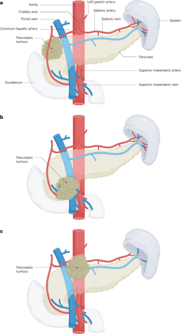 Preoperative chemotherapy, radiotherapy and surgical decision-making in patients with borderline resectable and locally advanced pancreatic cancer